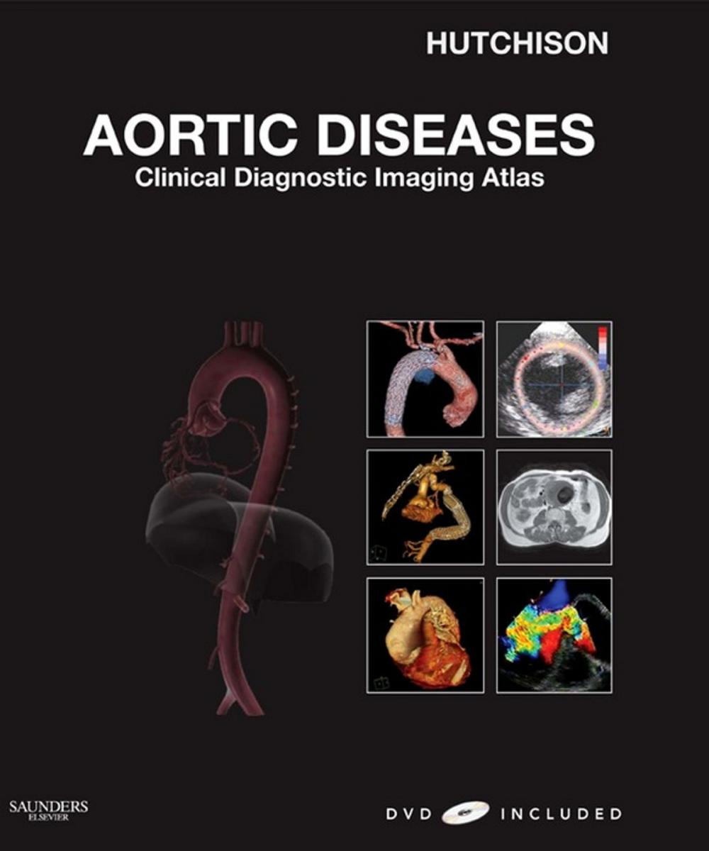 Big bigCover of Aortic Diseases E-Book