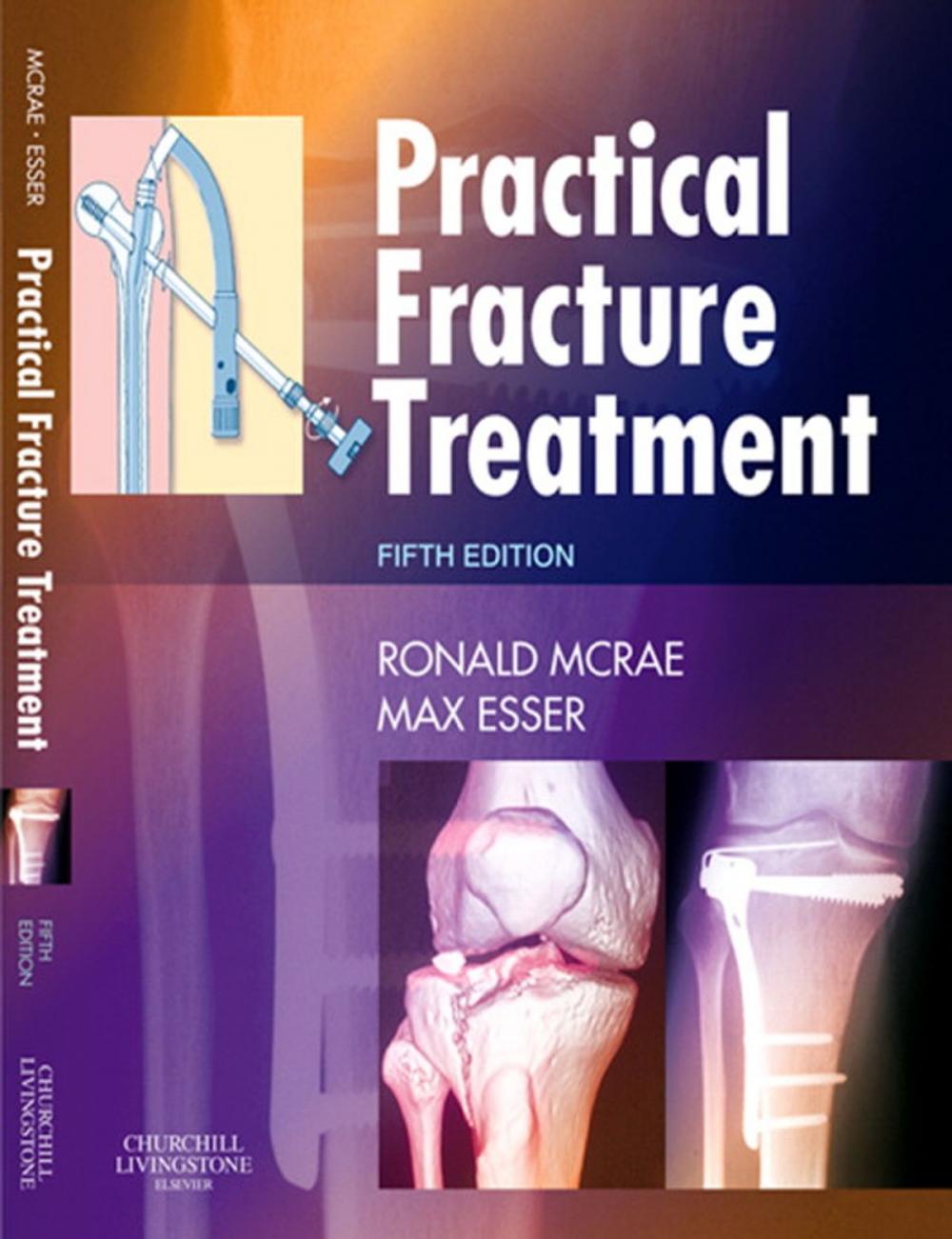 Big bigCover of Practical Fracture Treatment E-Book