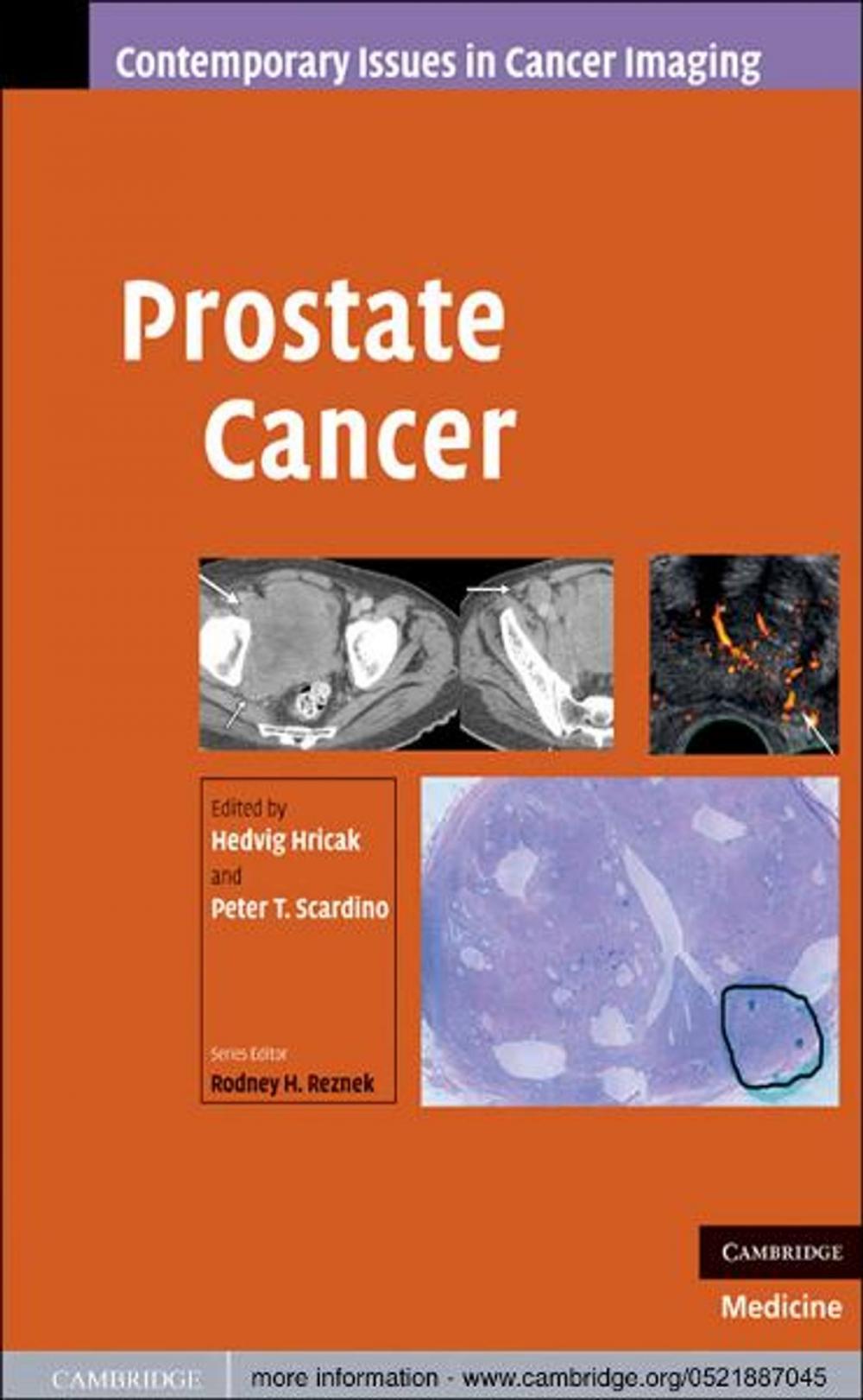 Big bigCover of Prostate Cancer