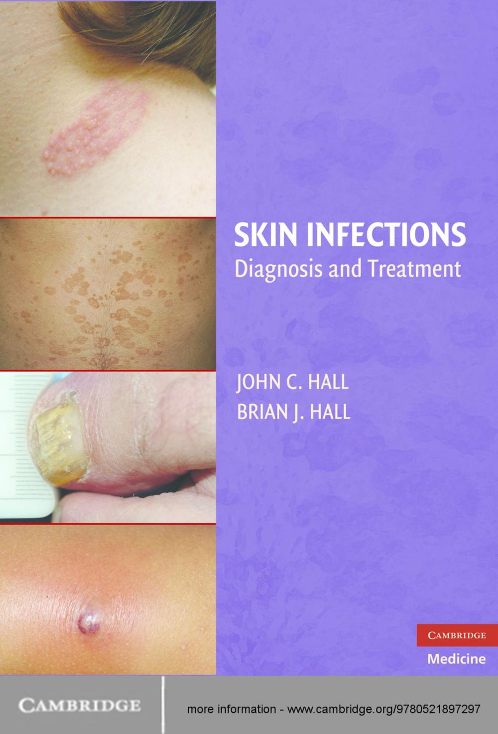 Big bigCover of Skin Infections