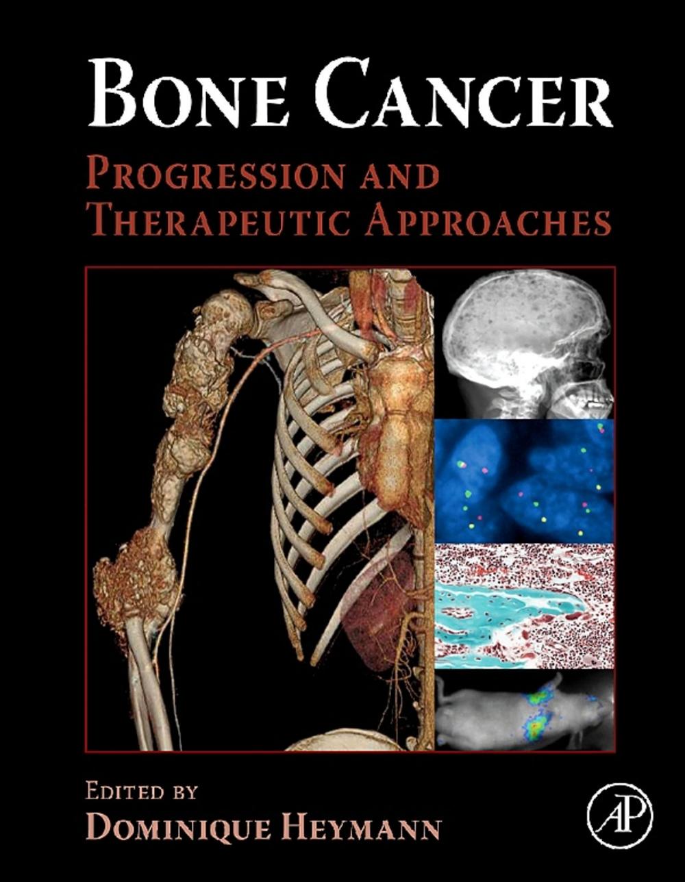 Big bigCover of Bone Cancer