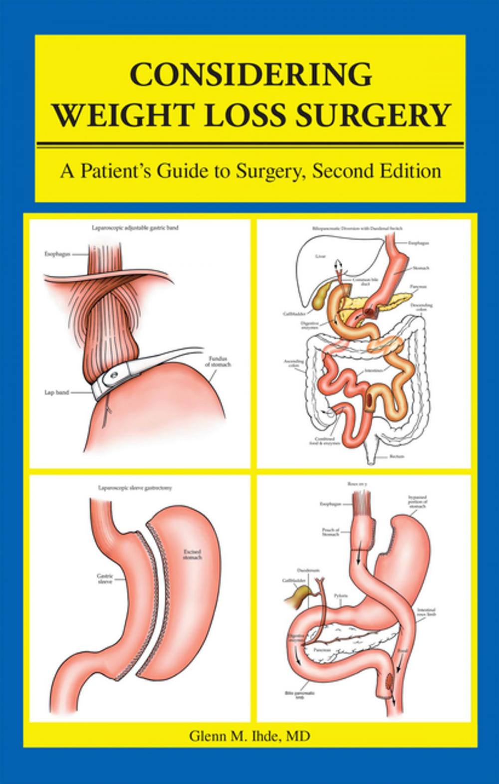 Big bigCover of Considering Weight Loss Surgery