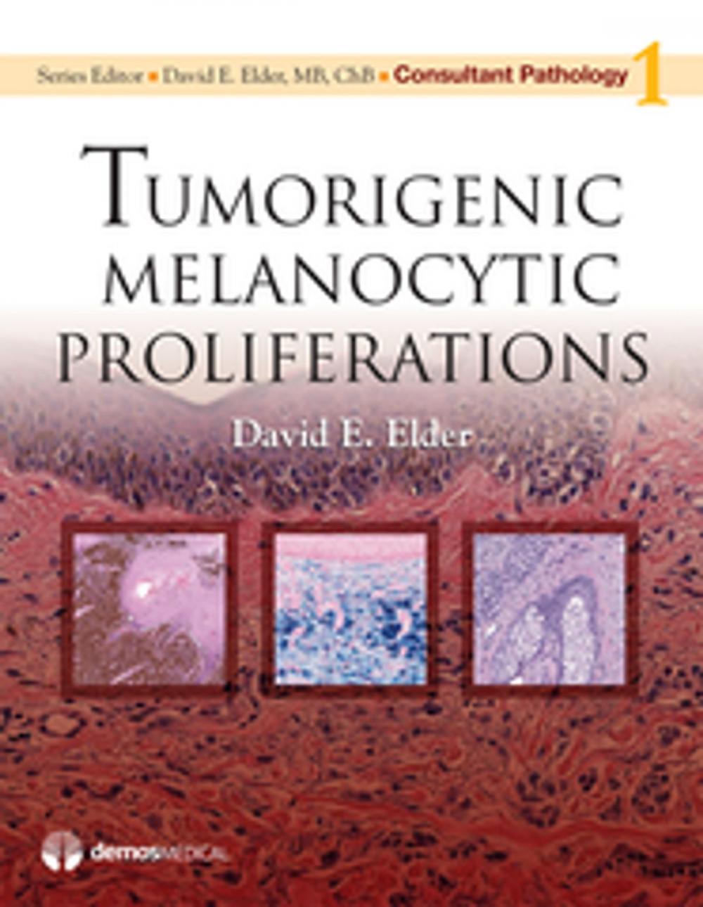 Big bigCover of Tumorigenic Melanocytic Proliferations