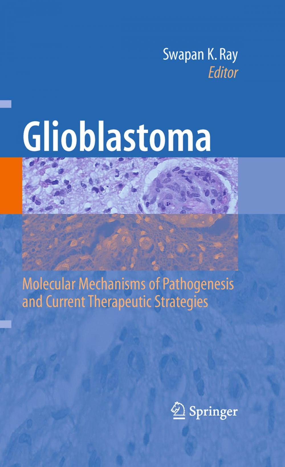 Big bigCover of Glioblastoma: