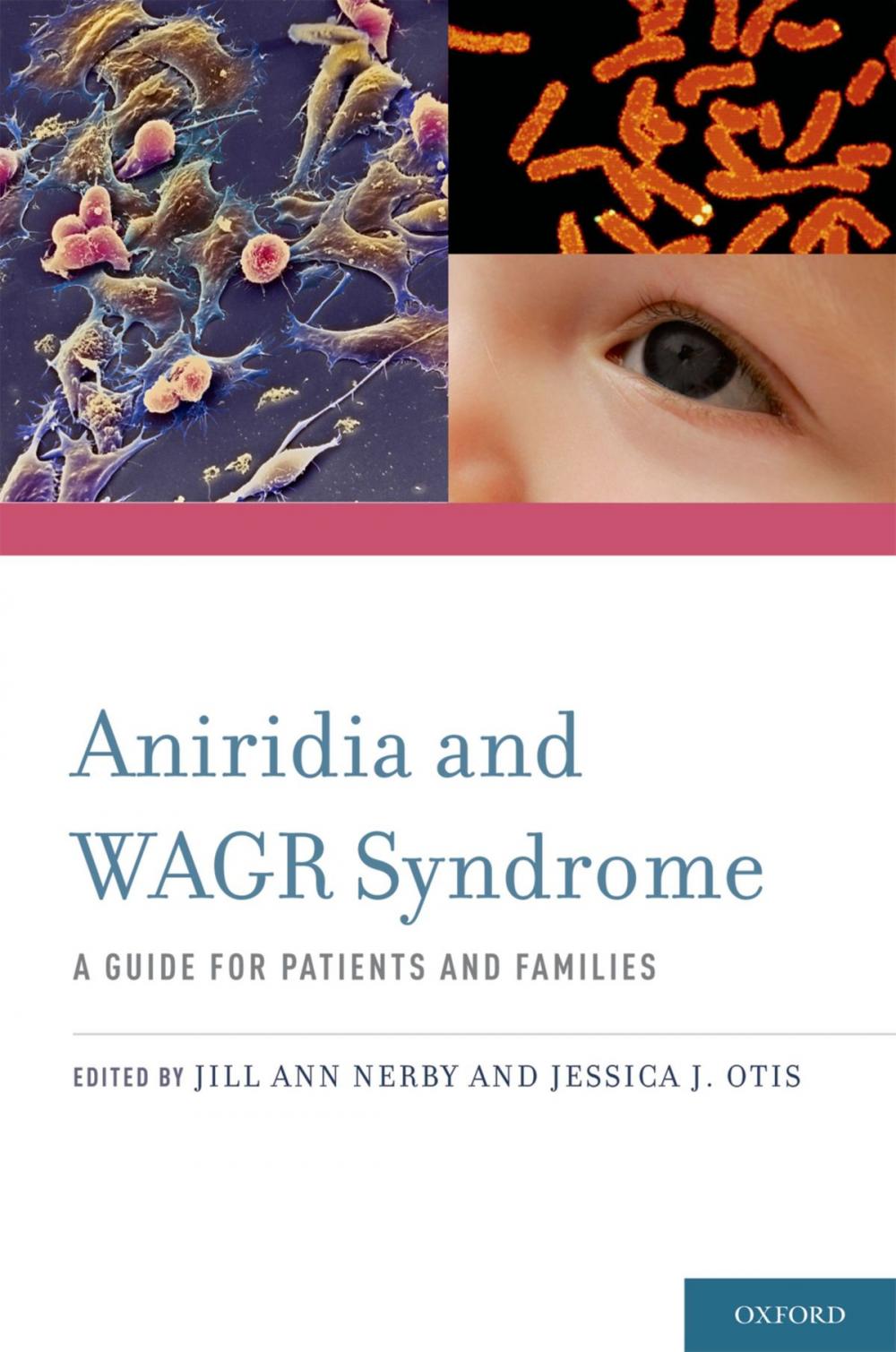 Big bigCover of Aniridia and WAGR Syndrome