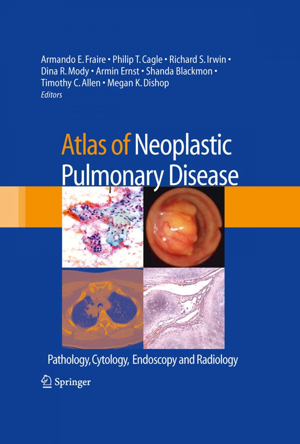 Big bigCover of Atlas of Neoplastic Pulmonary Disease