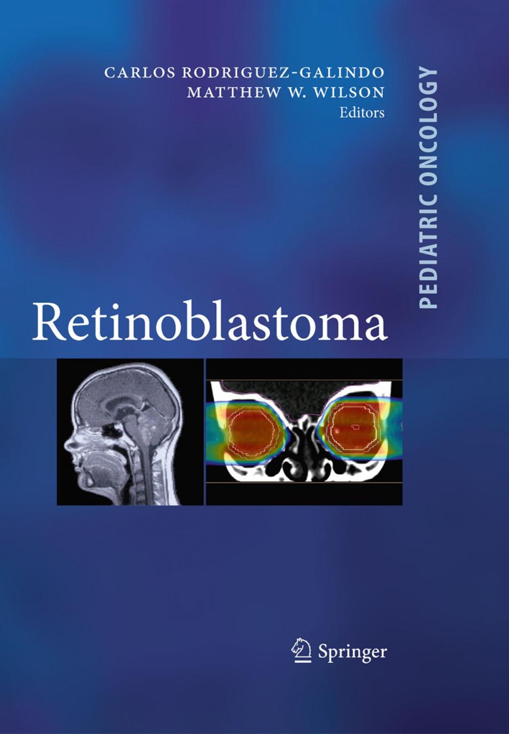 Big bigCover of Retinoblastoma