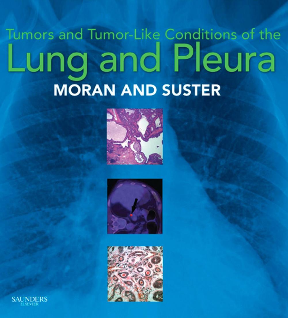 Big bigCover of Tumors and Tumor-like Conditions of the Lung and Pleura E-Book
