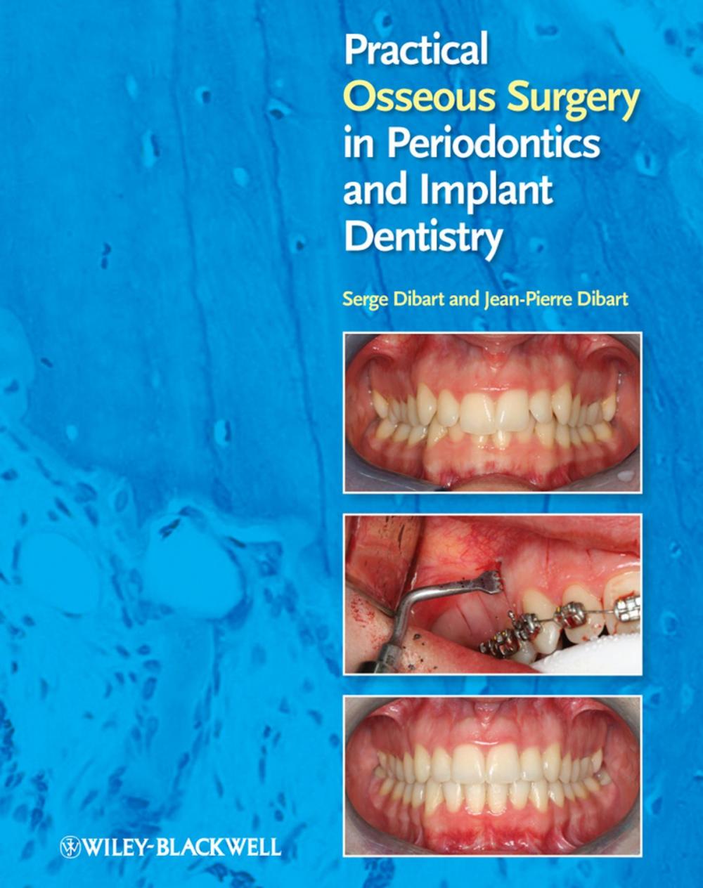 Big bigCover of Practical Osseous Surgery in Periodontics and Implant Dentistry