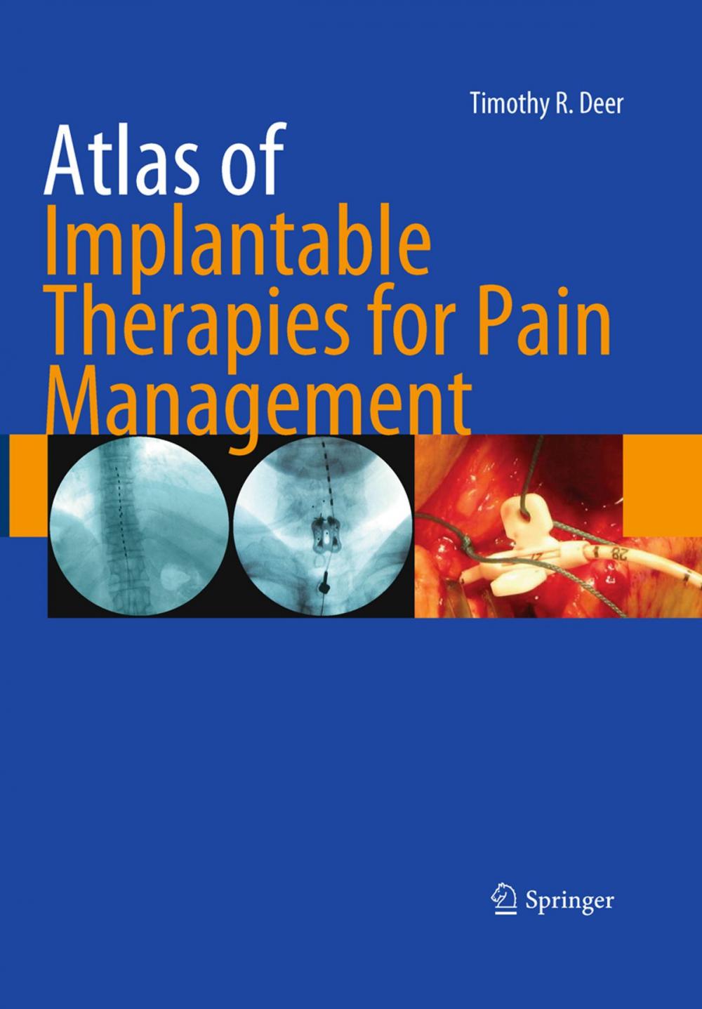 Big bigCover of Atlas of Implantable Therapies for Pain Management