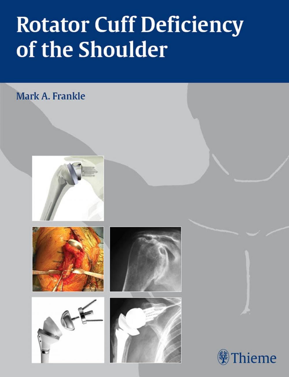 Big bigCover of Rotator Cuff Deficiency of the Shoulder