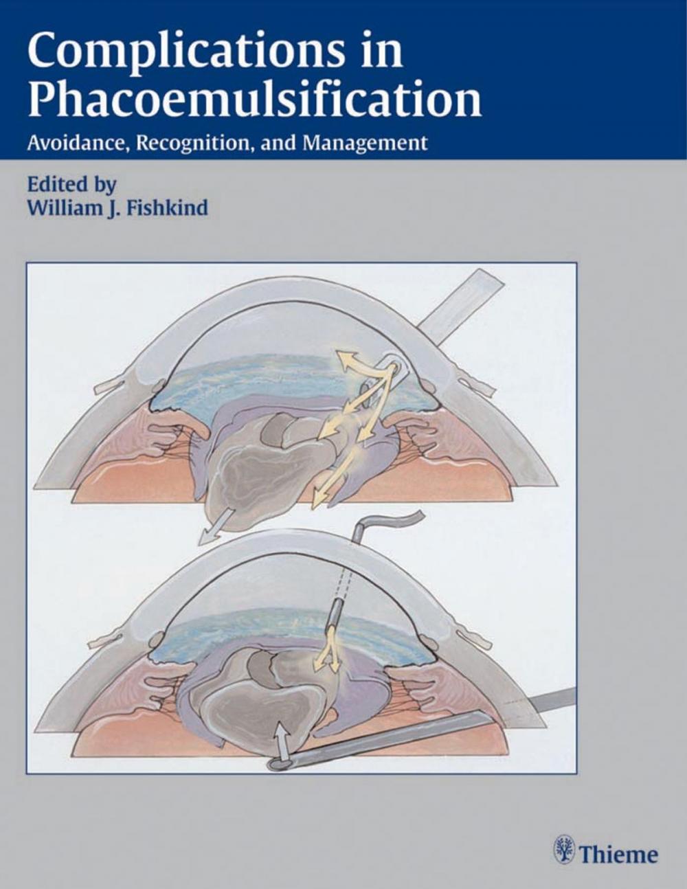 Big bigCover of Complications in Phacoemulsification