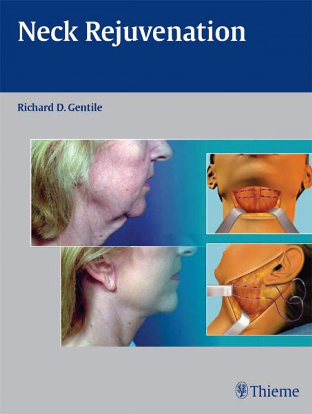 Big bigCover of Neck Rejuvenation