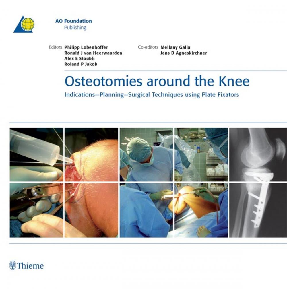 Big bigCover of Osteotomies around the Knee