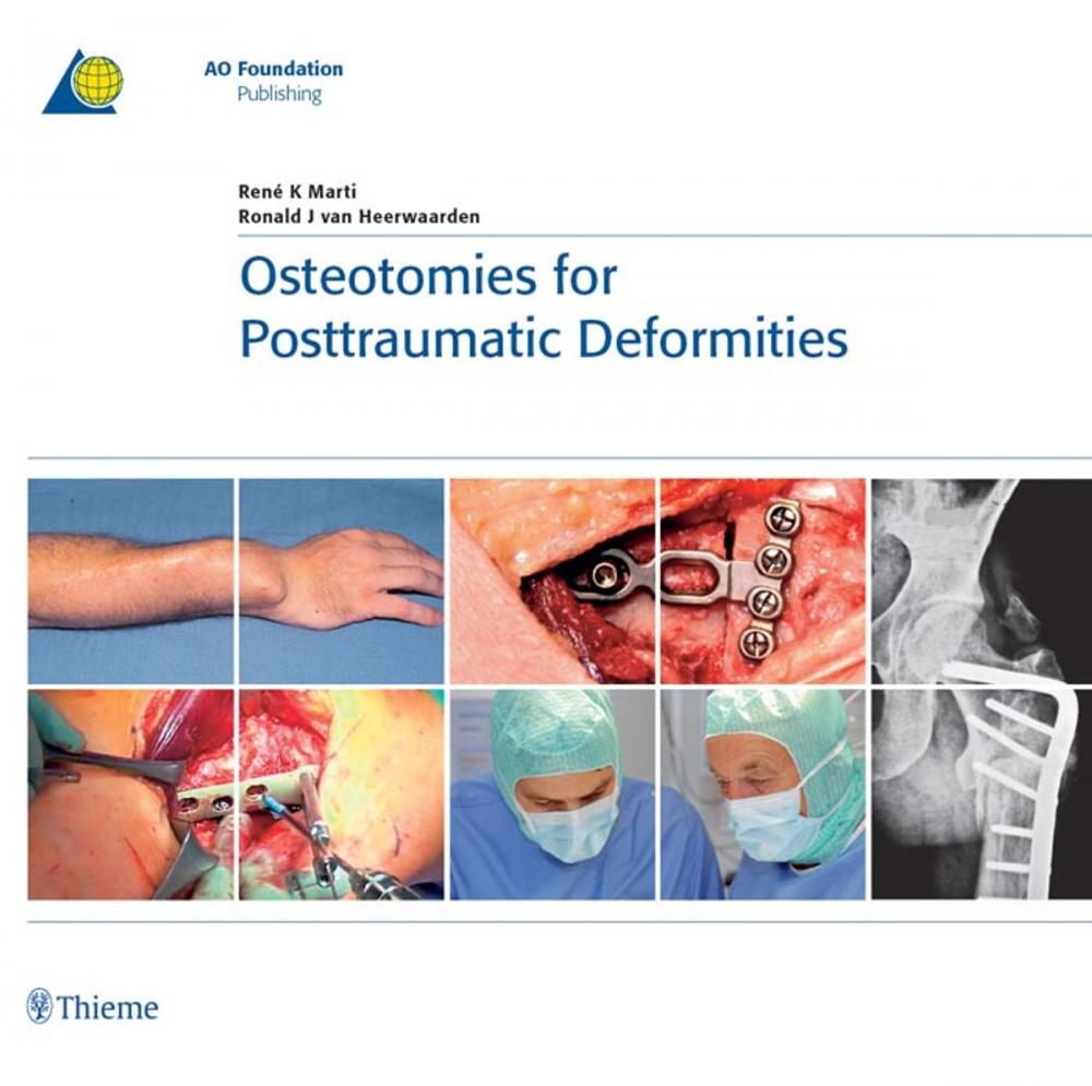 Big bigCover of Osteotomies for Posttraumatic Deformities