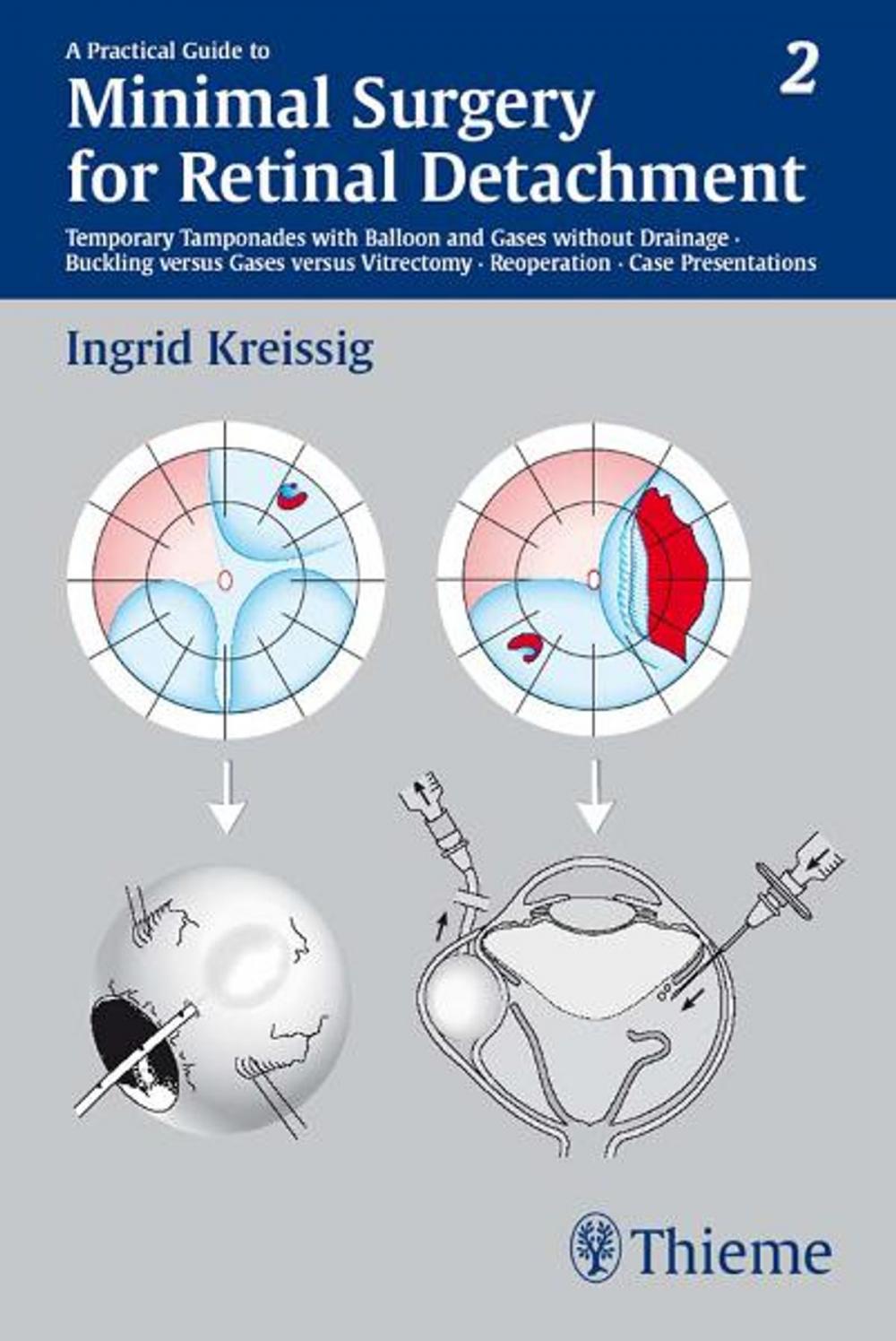 Big bigCover of Practical Guide to Minimal Surgery for Retinal Detachment, Volume II