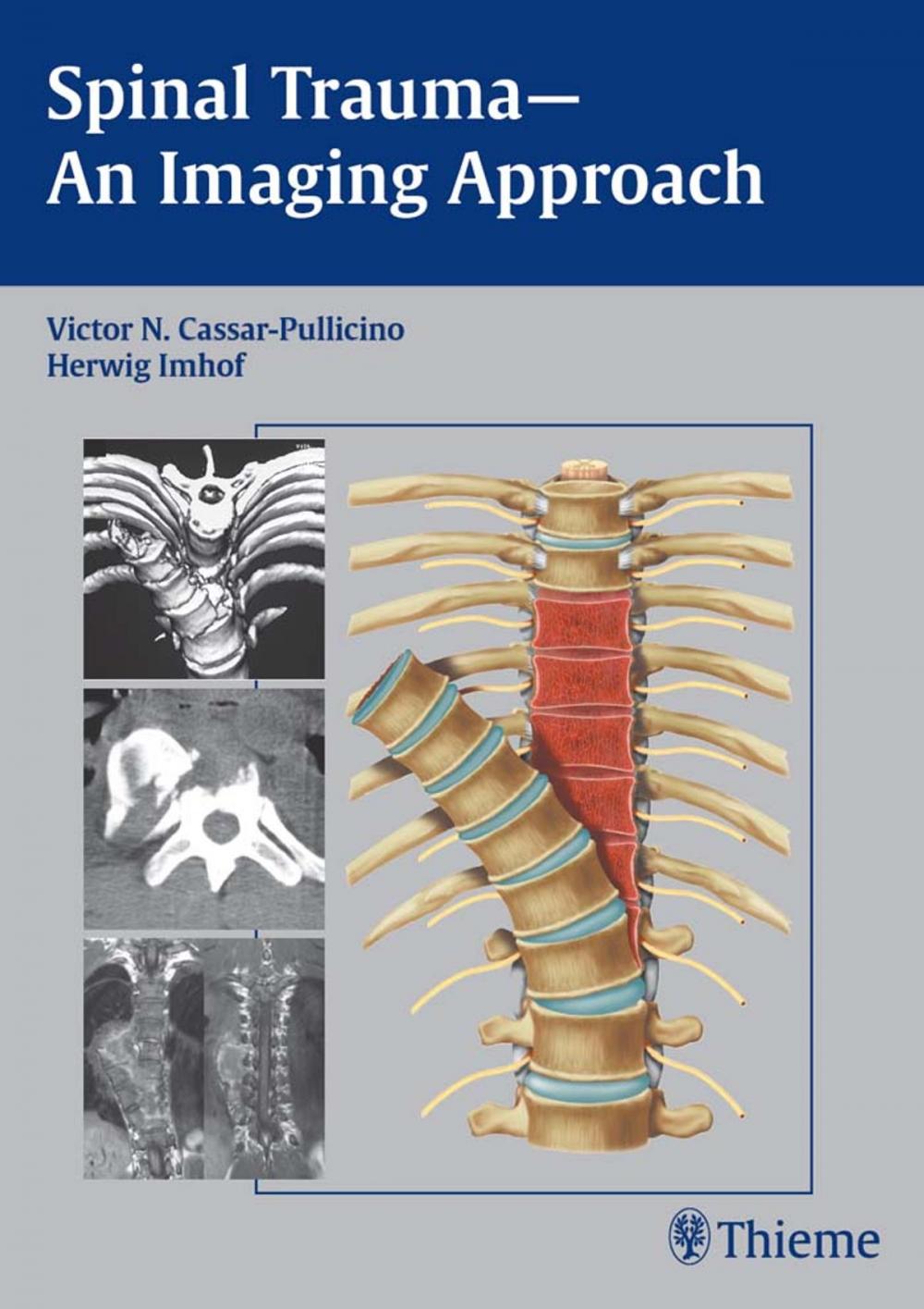 Big bigCover of Spinal Trauma - An Imaging Approach