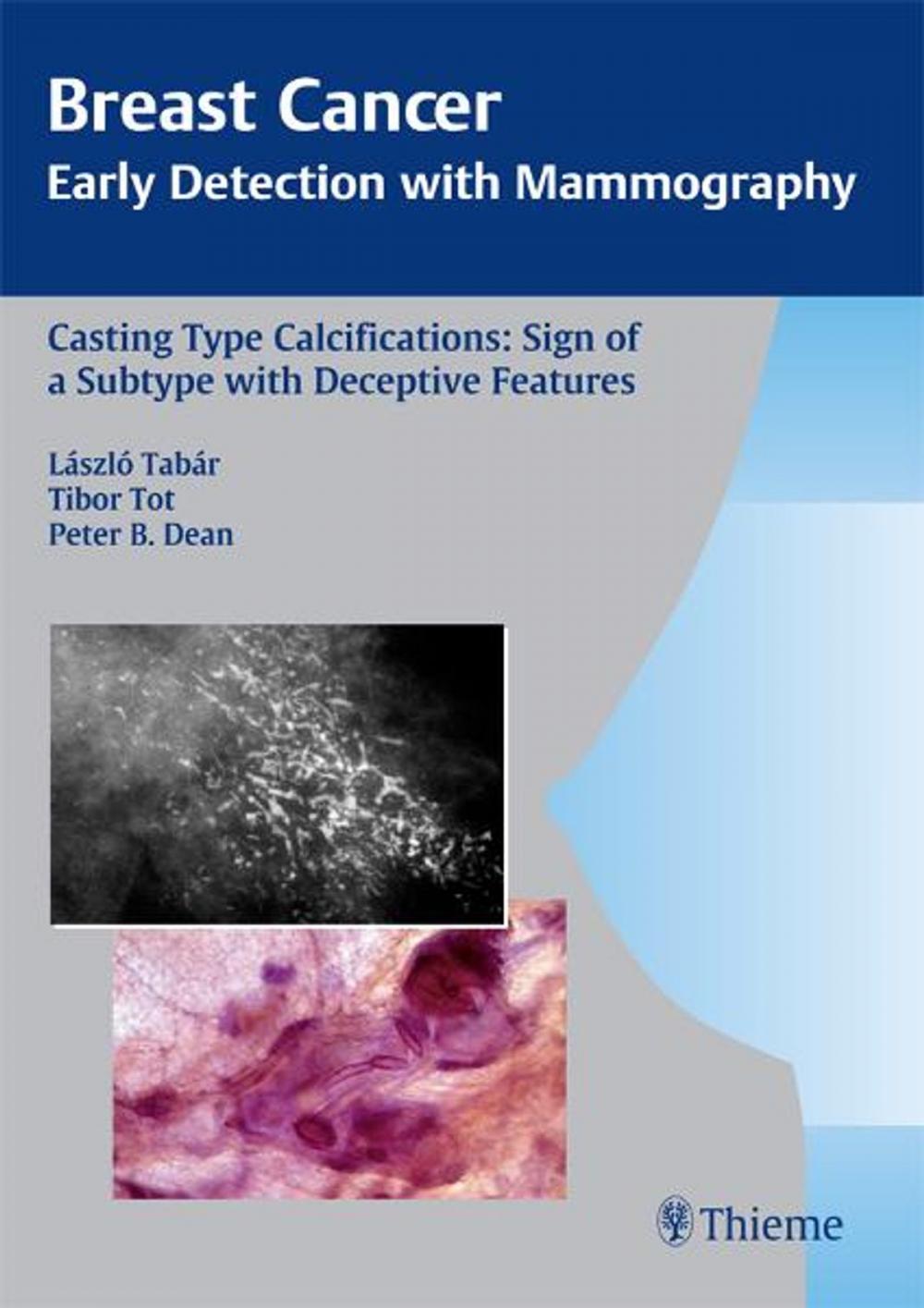 Big bigCover of Casting Type Calcifications: Sign of a Subtype with Deceptive Features