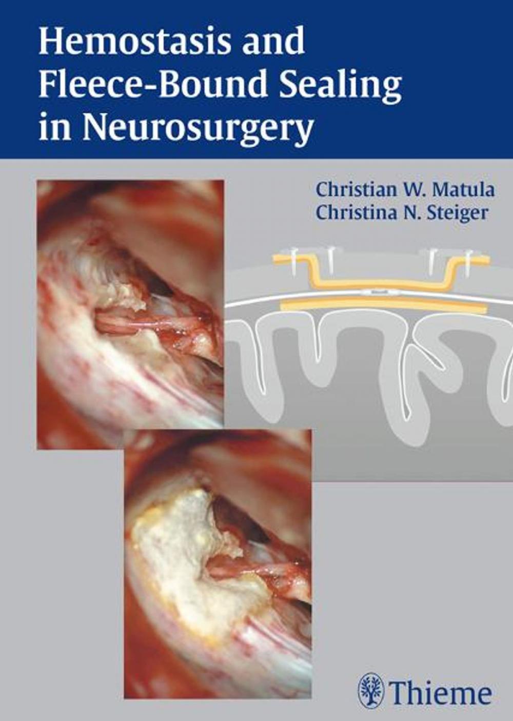 Big bigCover of Hemostasis and Fleece-Bound Sealing in Neurosurgery