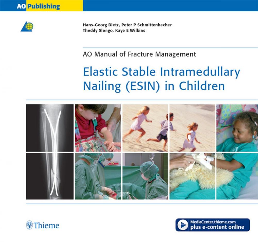 Big bigCover of Elastic Stable Intramedullary Nailing (ESIN) in Children