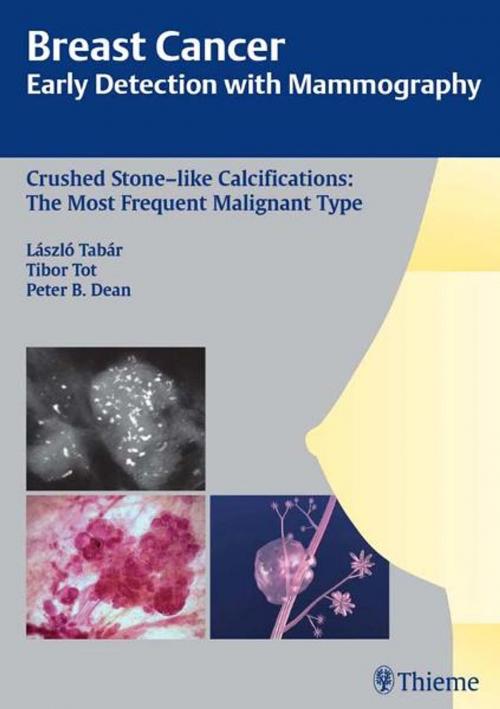 Cover of the book Breast Cancer: Early Detection with Mammography by Laszlo Tabar, Tibor Tot, Thieme