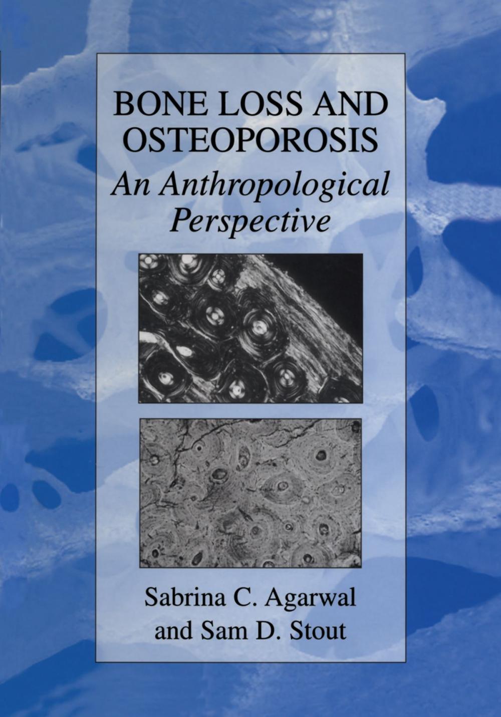 Big bigCover of Bone Loss and Osteoporosis