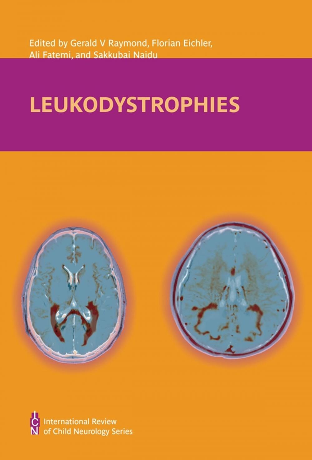 Big bigCover of Leukodystrophies