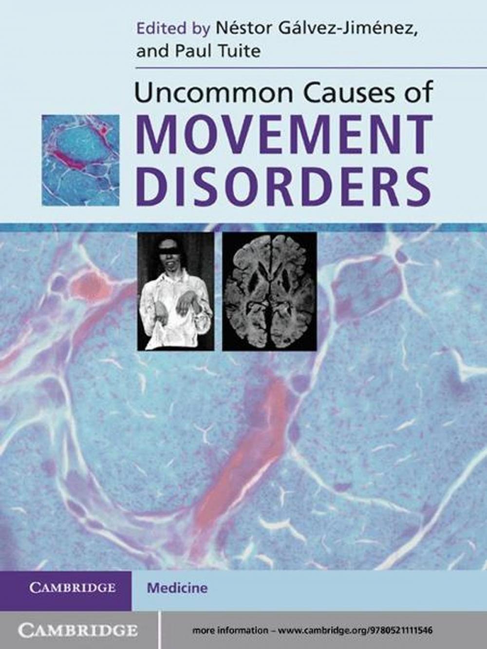 Big bigCover of Uncommon Causes of Movement Disorders