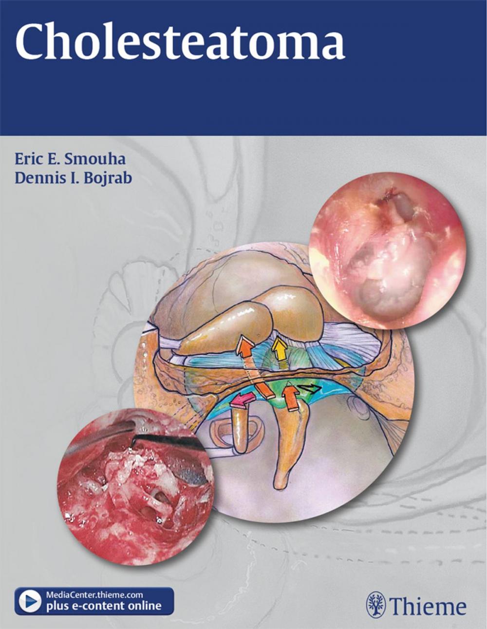 Big bigCover of Cholesteatoma