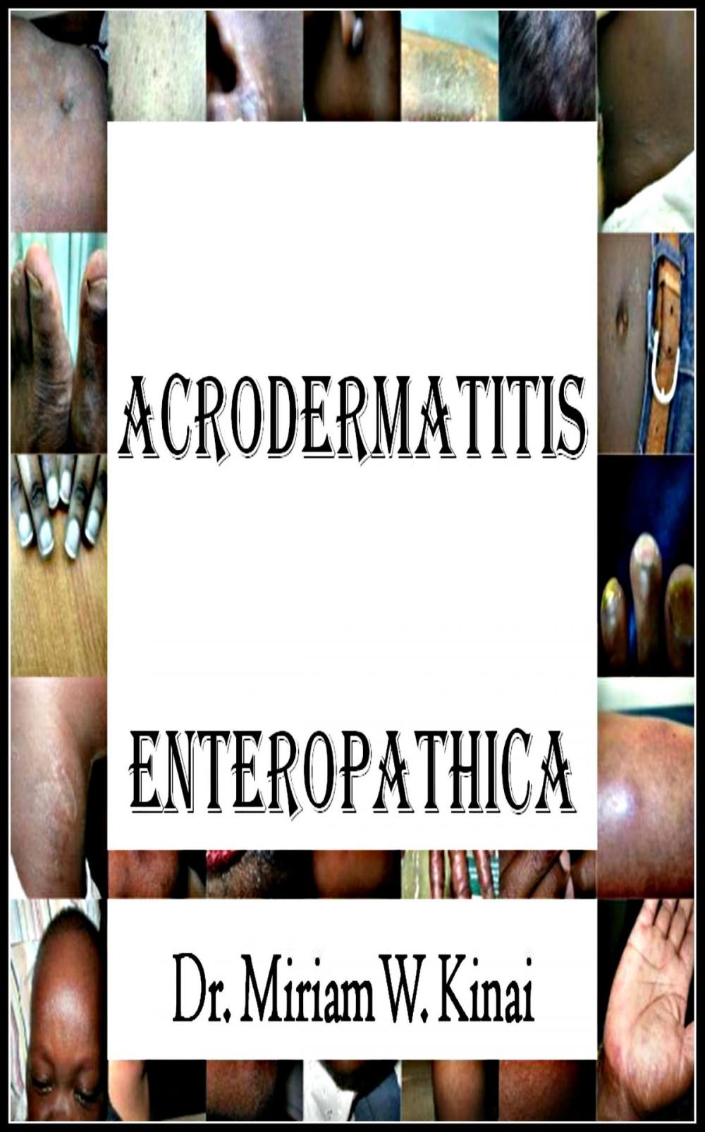 Big bigCover of Acrodermatitis Enteropathica