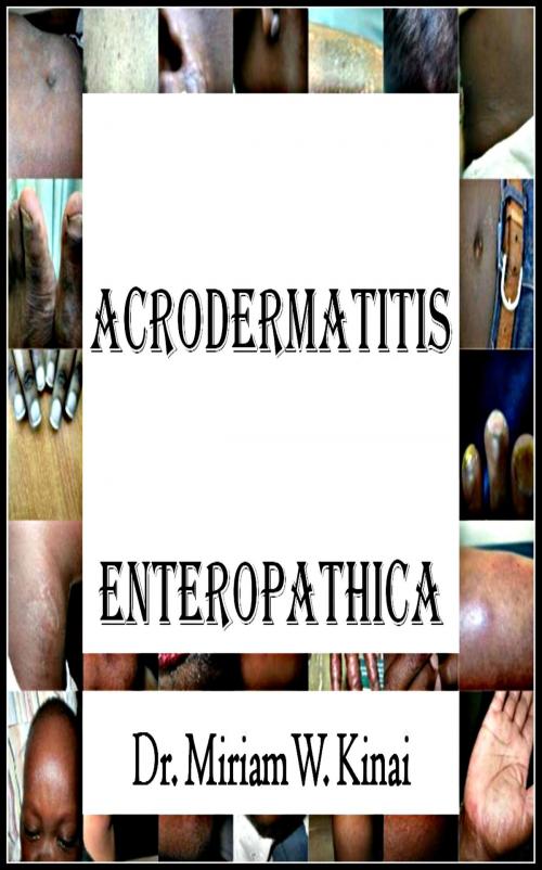 Cover of the book Acrodermatitis Enteropathica by Miriam Kinai, Miriam Kinai