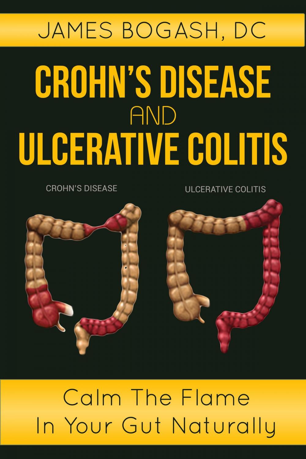 Big bigCover of Crohn's Disease and Ulcerative Colitis: Calm the Flame in Your Gut Naturally