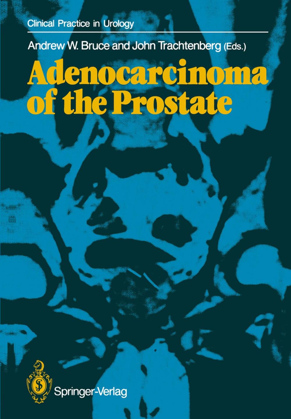 Big bigCover of Adenocarcinoma of the Prostate