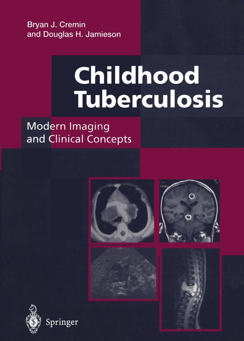 Big bigCover of Childhood Tuberculosis: Modern Imaging and Clinical Concepts