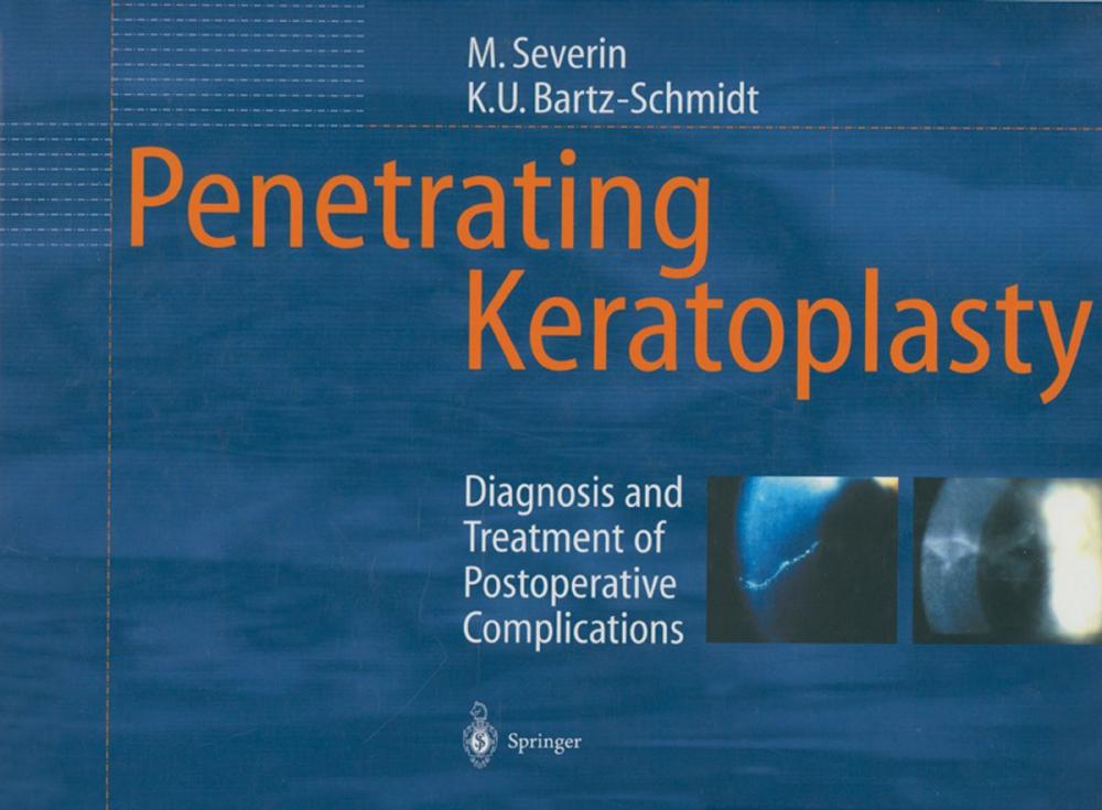 Big bigCover of Penetrating Keratoplasty