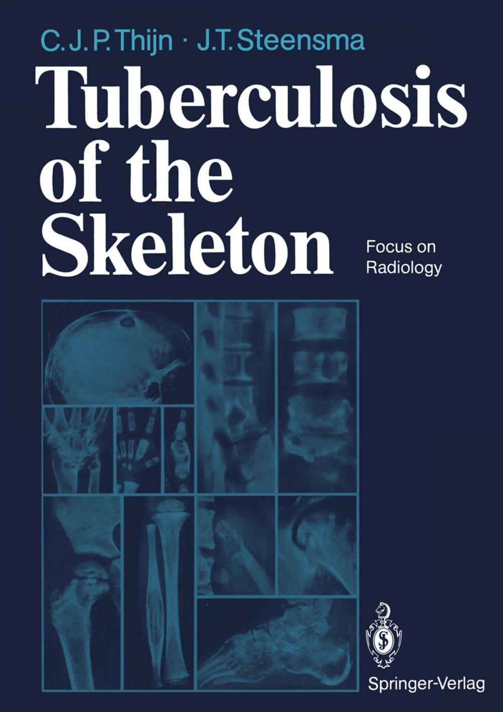 Big bigCover of Tuberculosis of the Skeleton