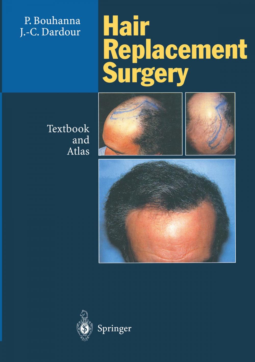 Big bigCover of Hair Replacement Surgery