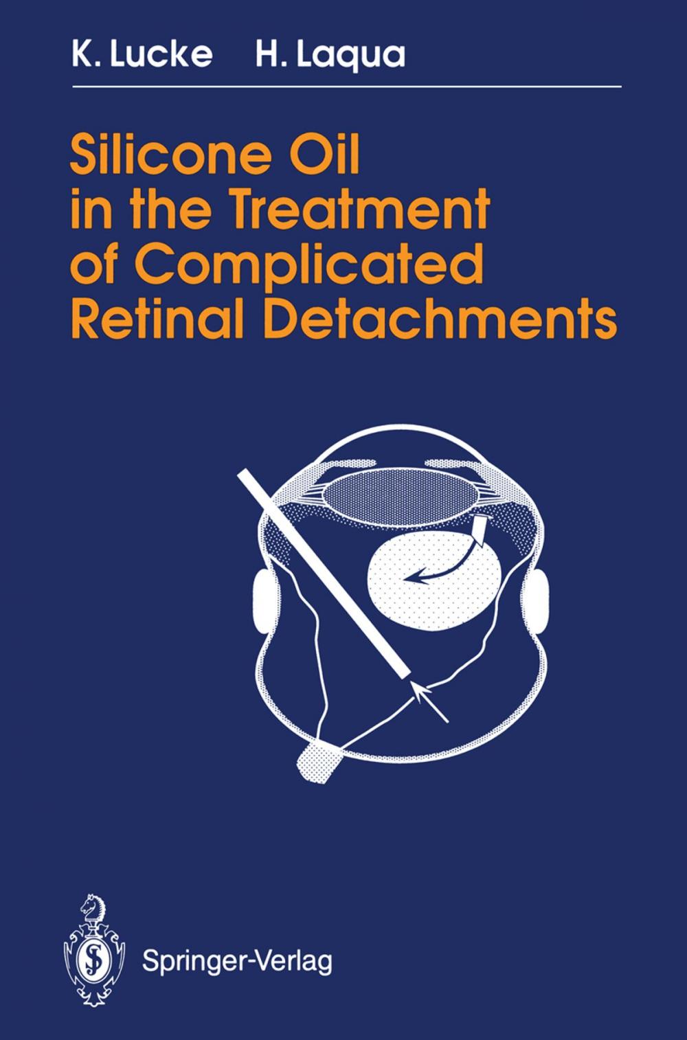 Big bigCover of Silicone Oil in the Treatment of Complicated Retinal Detachments