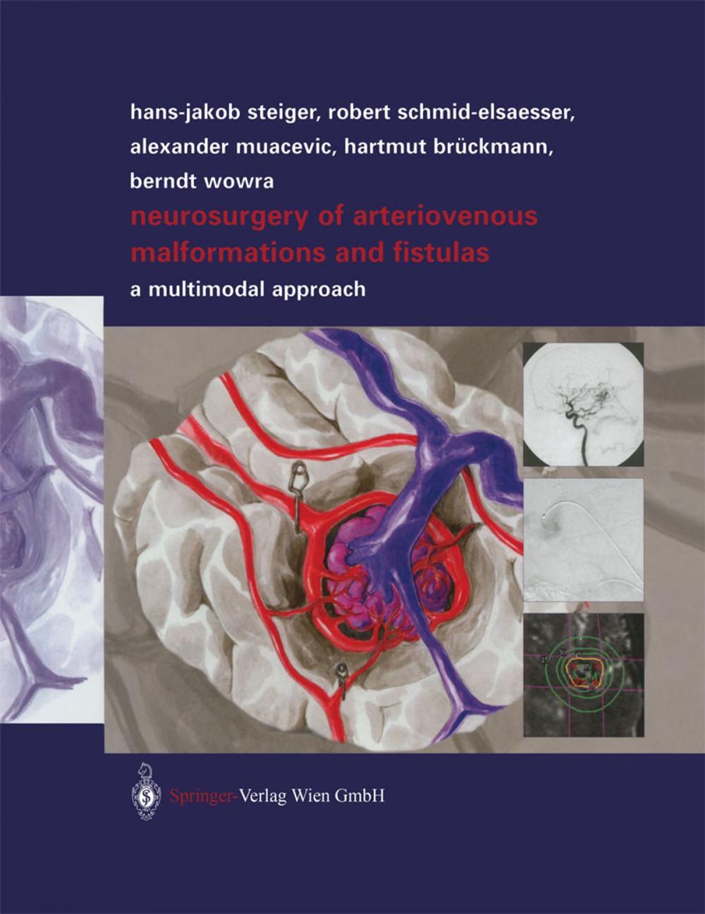 Big bigCover of Neurosurgery of Arteriovenous Malformations and Fistulas