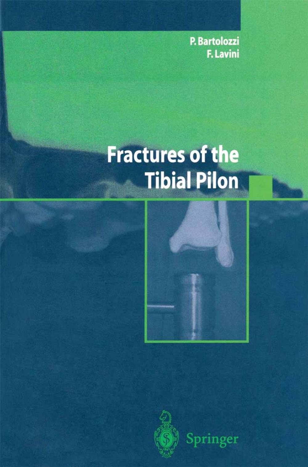 Big bigCover of Fractures of the Tibial Pilon