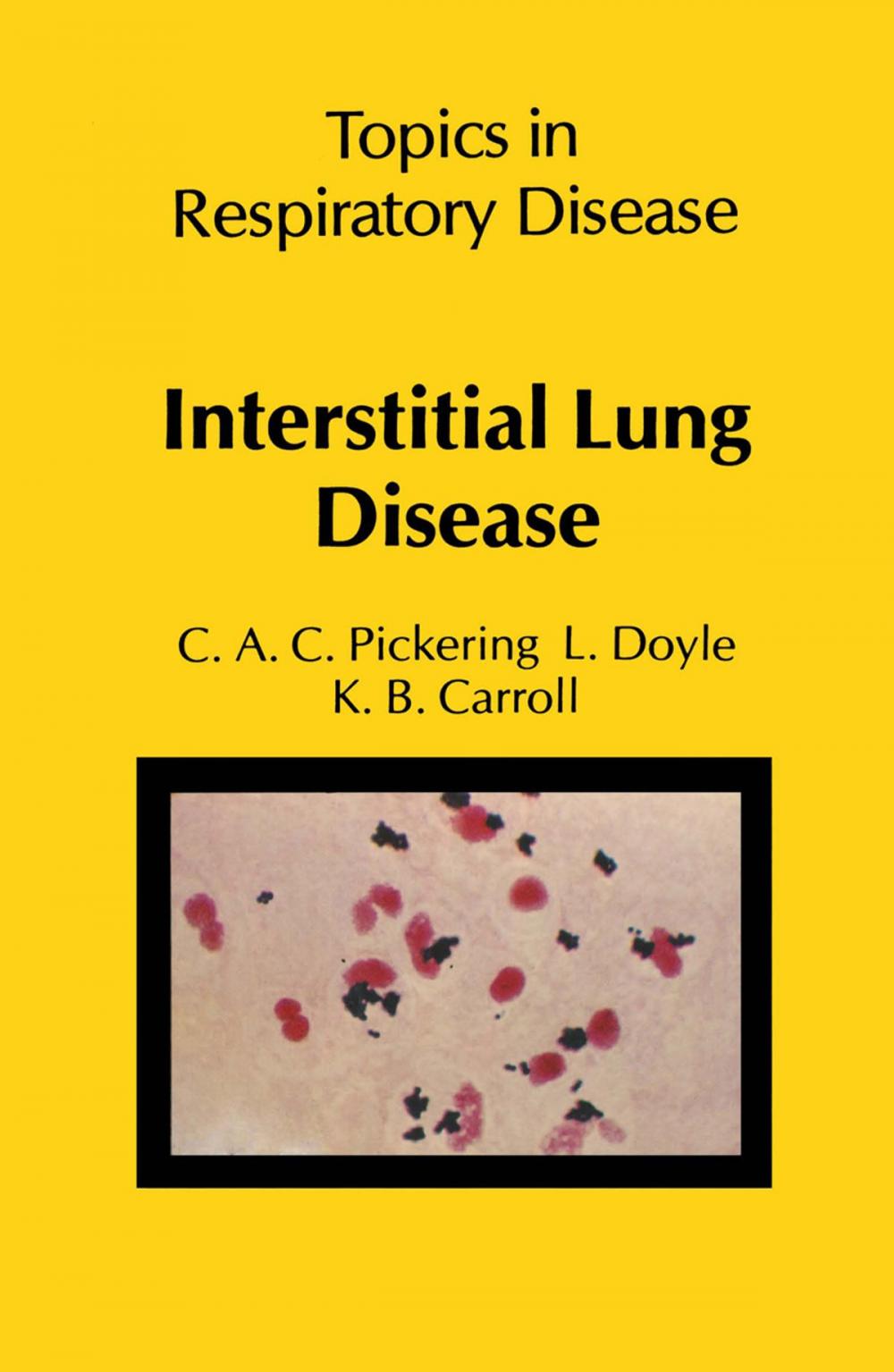 Big bigCover of Interstitial Lung Disease