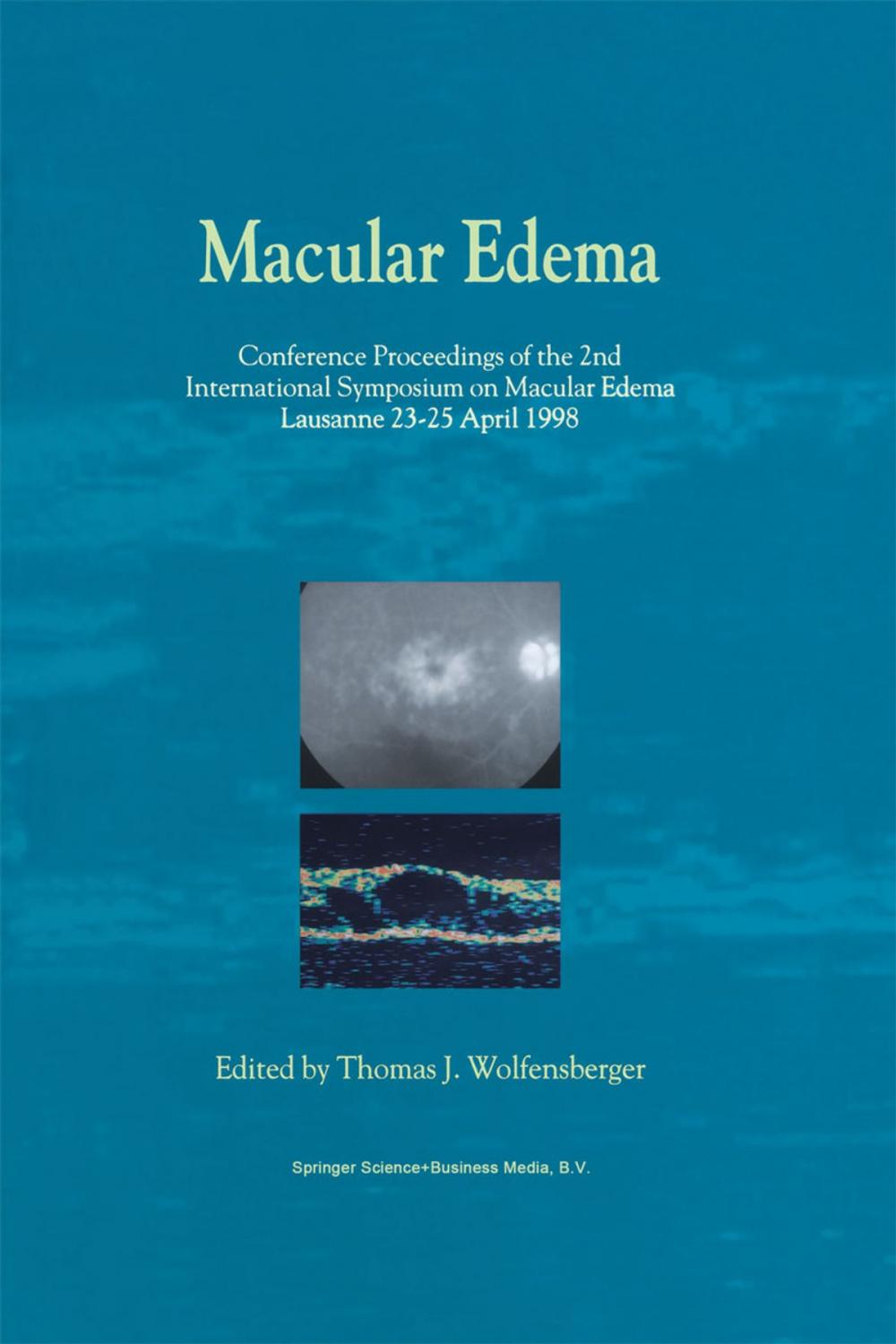 Big bigCover of Macular Edema