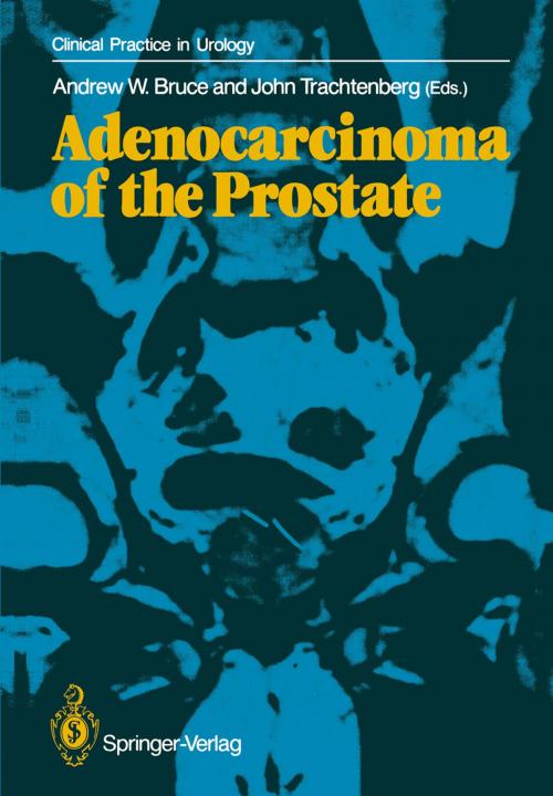 Cover of the book Adenocarcinoma of the Prostate by , Springer London