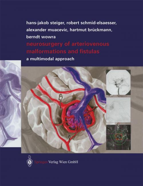 Cover of the book Neurosurgery of Arteriovenous Malformations and Fistulas by Robert Schmid-Elsaesser, Alexander Muacevic, Hartmut Brückmann, Berndt Wowra, Springer Vienna