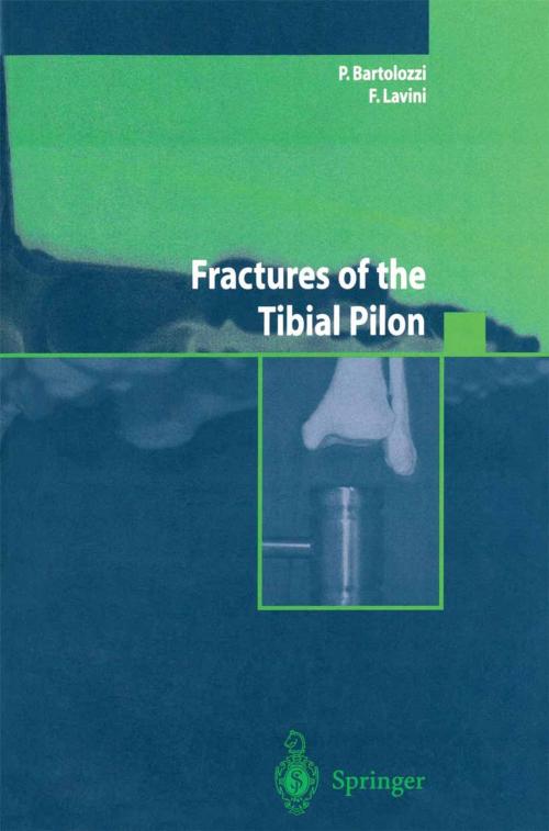 Cover of the book Fractures of the Tibial Pilon by P. Bartolozzi, F. Lavini, Springer Milan