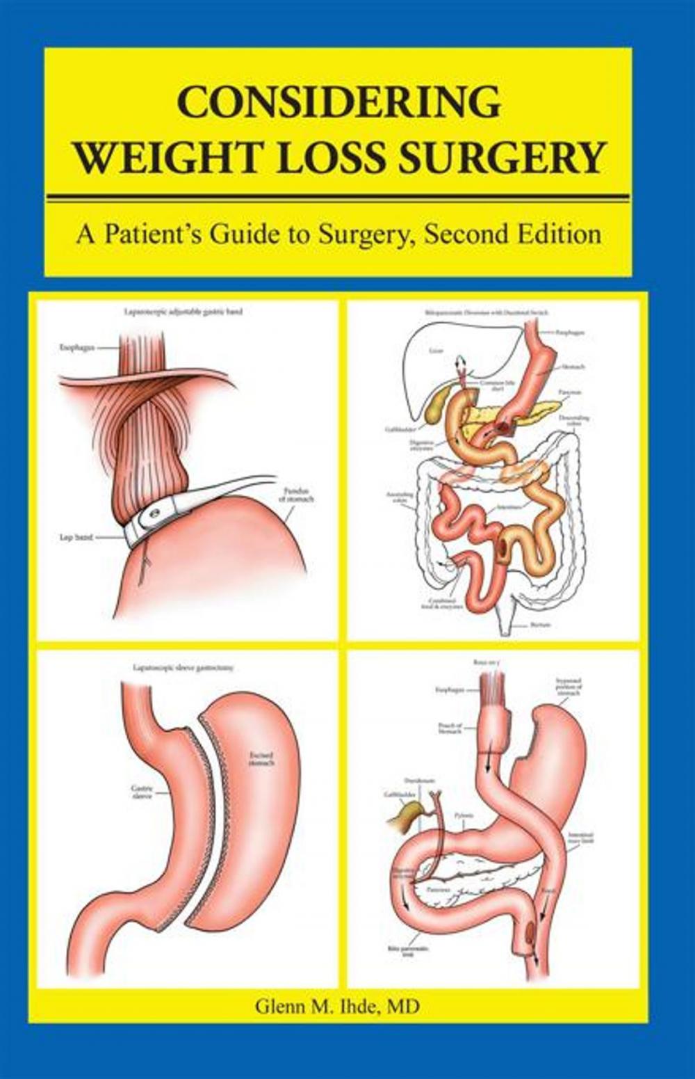 Big bigCover of Considering Weight Loss Surgery