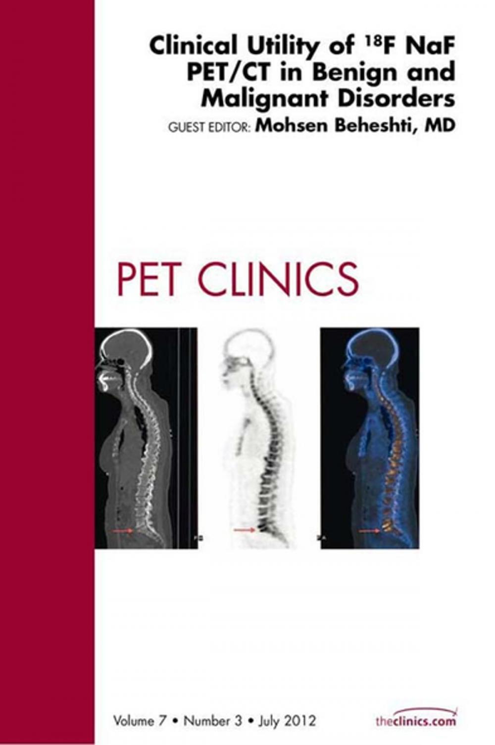 Big bigCover of Clinical Utility of 18NaF PET/CT in Benign and Malignant Disorders, An Issue of PET Clinics - E-Book