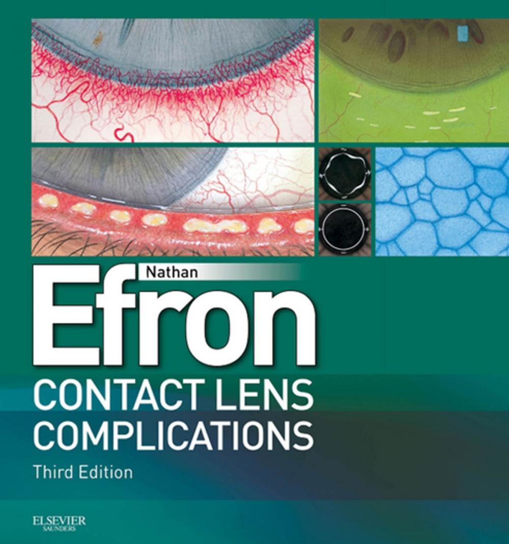 Big bigCover of Contact Lens Complications E-Book