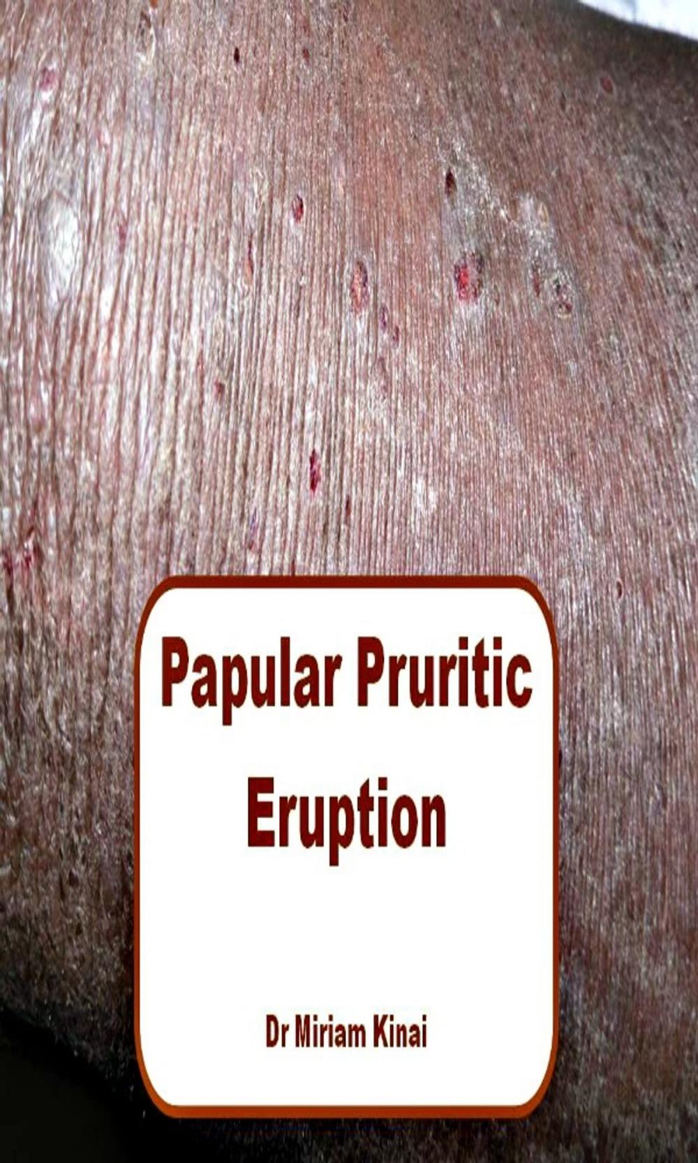 Big bigCover of Papular Pruritic Eruption (PPE)