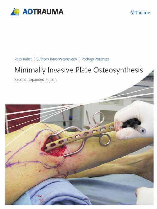 Cover of the book Minimally Invasive Plate Osteosynthesis (MIPO) by Reto Babst, Suthorn Bavonratanavech, Rodrigo F. Pesantez, Thieme/AO